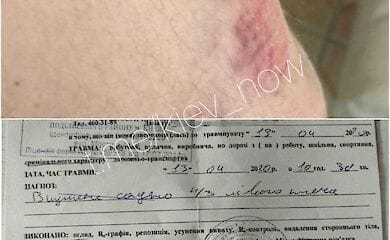В Киеве неадекватная женщина покусала в очереди мужчину
