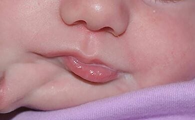 Медикам удалось прооперировать полугодовалую девочку, которая родилась с двумя ртами