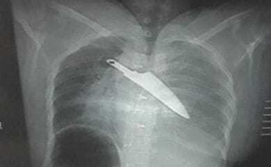 Жінка вижила після того, як добу провела з ножем у грудях