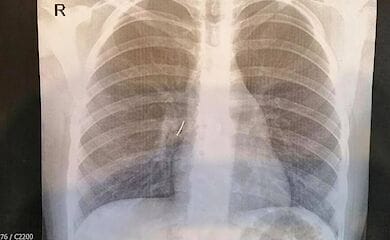 Девочка во время прогулки с друзьями вдохнула канцелярский гвоздь, которій застрял в бронхах