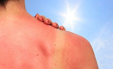 Осторожно, солнце: первая помощь при солнечных ожогах