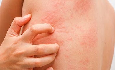 Учёные рассказали, что зуд может быть признаком онкологии