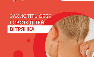 Пневмонія та енцефаліт: лікарі розповіли про ускладнення вітрянки