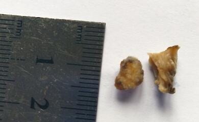 Медики успешно провели операцию по удалению каменного обломока из сердца военного