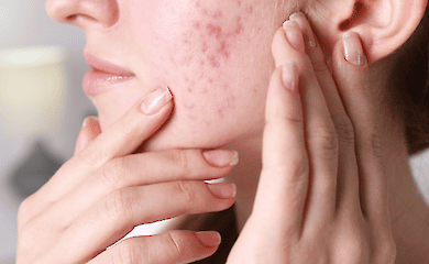 Проверь свою косметичку: ТОП-7 врагов проблемной кожи