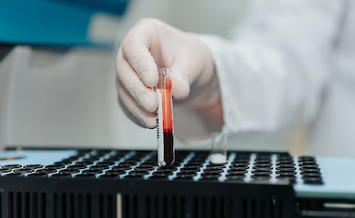 ИИ обнаруживает рак кишечника на любой стадии по анализу крови