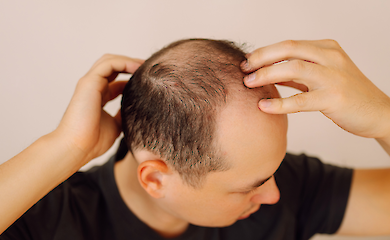 Звичайний підсолоджувач може стати ключем до боротьби з облисінням