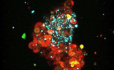 Учені знайшли спосіб зробити люмінальний рак молочної залози вразливим для імунної системи