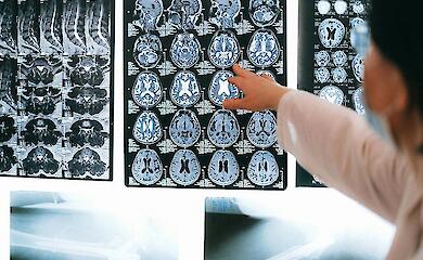 МРТ може виявити Альцгеймер на ранній стадії - нове дослідження з Азії 