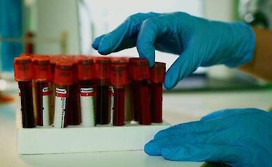 Аналіз крові допоміг передбачити, хто проживе довше - дослідження