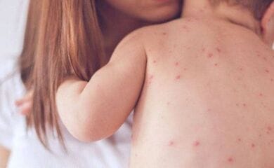 Гепатит, аппендицит и менингит причислили к осложнениям от кори