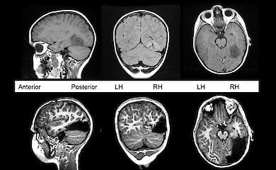 Виявлено новий вид шизофренії